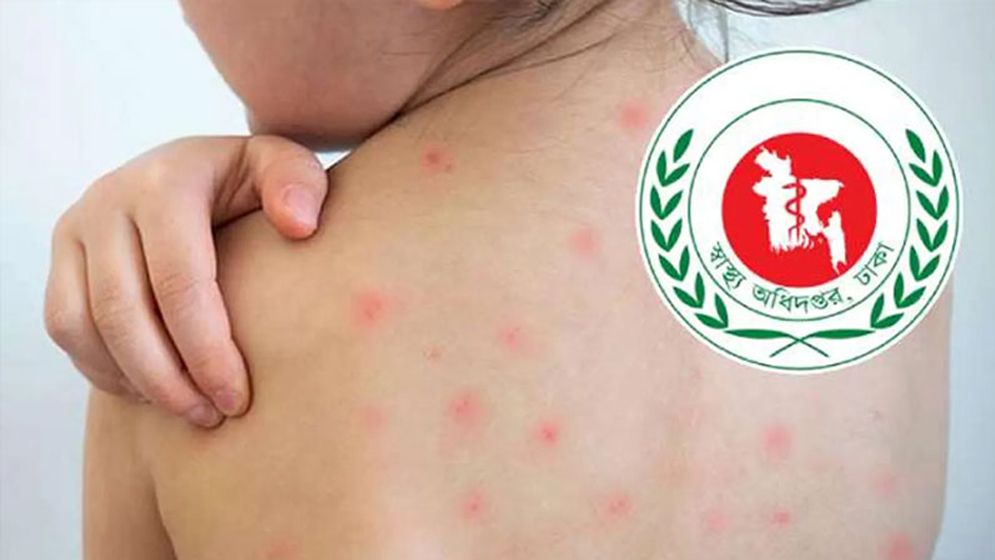 হামের উপসর্গে আরও ১ মৃত্যু, নতুন রোগী ১১৫৪
