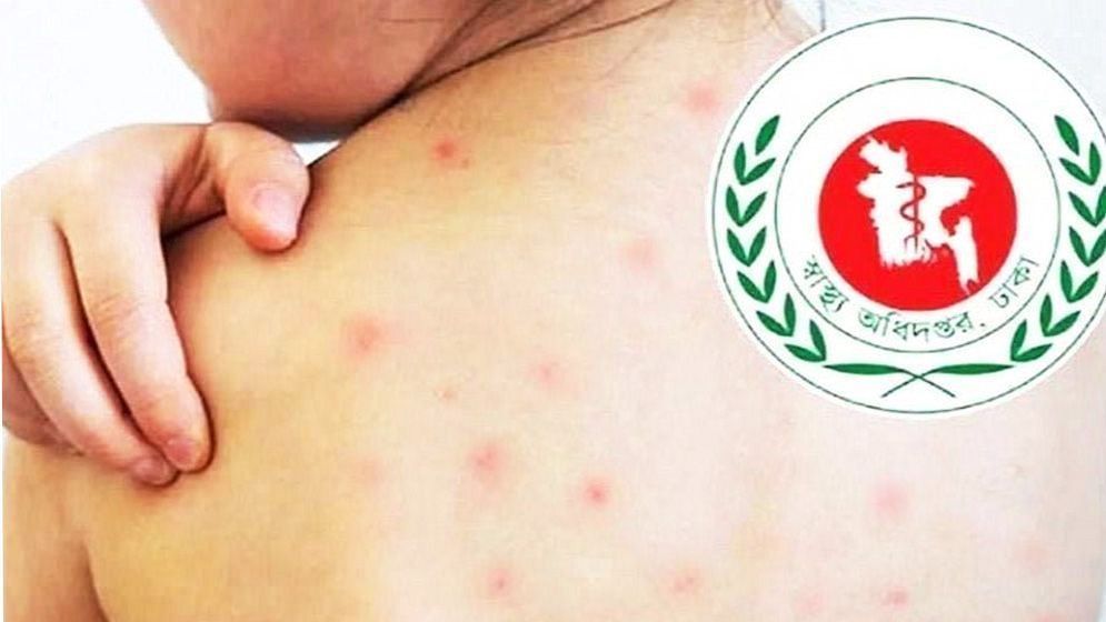 ২৪ ঘণ্টায় হাম উপসর্গে আরও ৭ জনের মৃত্যু